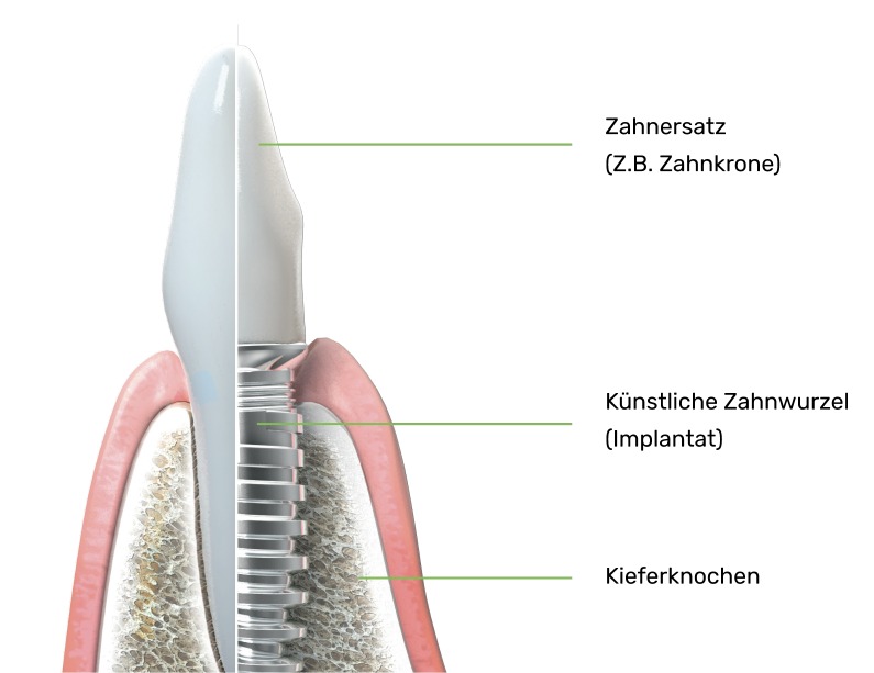 Was ist ein Zahnimplantat?